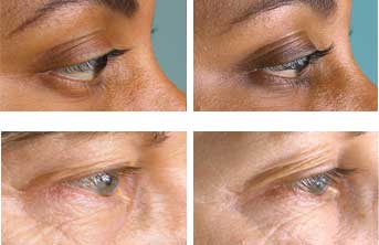 eyelash-serum-before-after-2 eyelash-serum-before-after-2