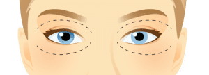 Cosmetic Blepharoplasty Cosmetic Blepharoplasty