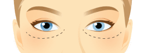 Lower Blepharoplasty Lower Blepharoplasty