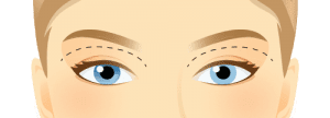 Functional Upper Eyelid Blepharoplasty Functional Upper Eyelid Blepharoplasty