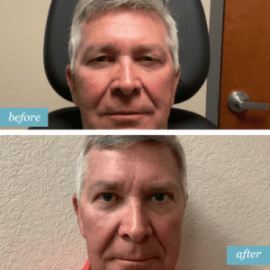 Before and After Blepharoplasty Patient Collins Vision